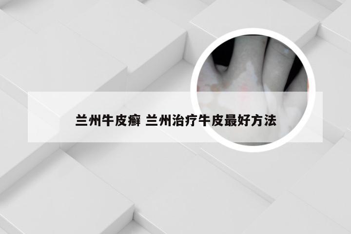 兰州牛皮癣 兰州治疗牛皮最好方法
