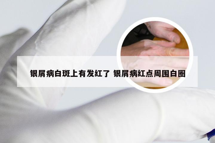 银屑病白斑上有发红了 银屑病红点周围白圈
