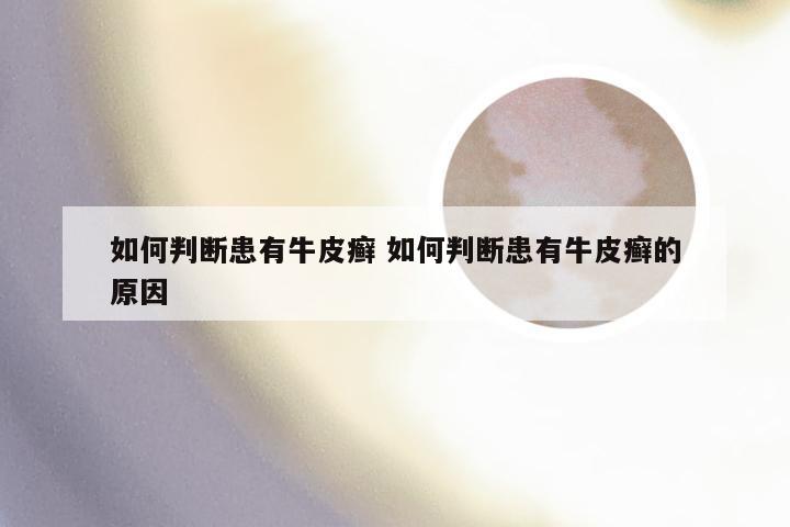 如何判断患有牛皮癣 如何判断患有牛皮癣的原因