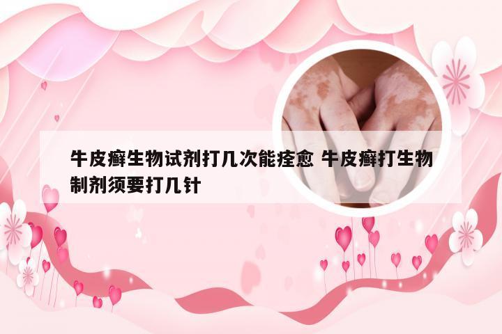 牛皮癣生物试剂打几次能痊愈 牛皮癣打生物制剂须要打几针