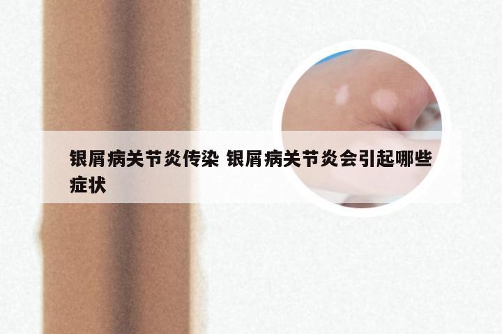 银屑病关节炎传染 银屑病关节炎会引起哪些症状