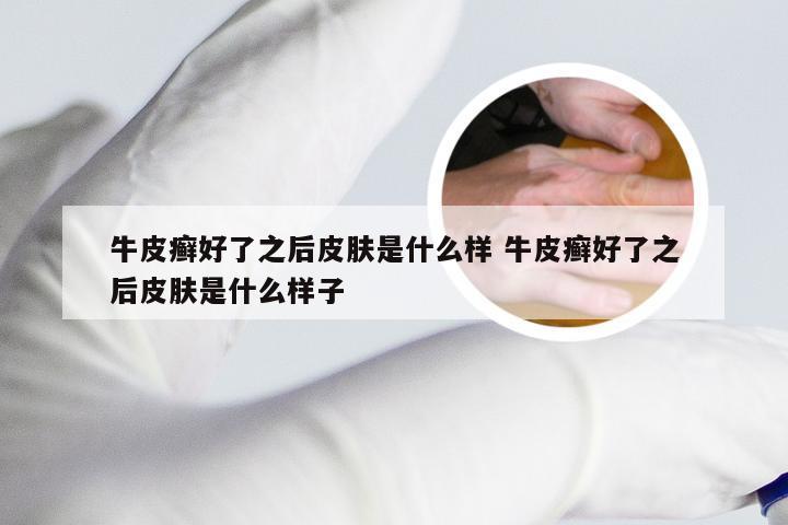 牛皮癣好了之后皮肤是什么样 牛皮癣好了之后皮肤是什么样子