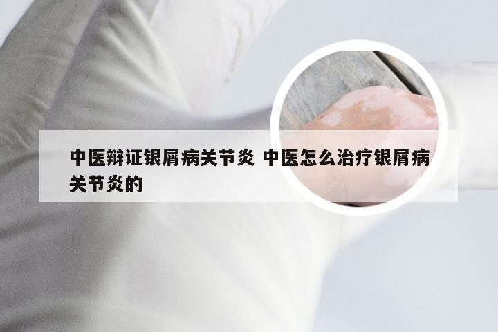 中医辩证银屑病关节炎 中医怎么治疗银屑病关节炎的