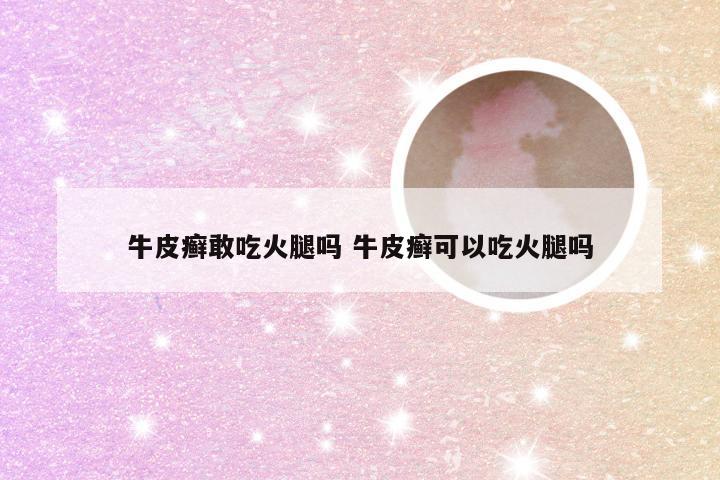 牛皮癣敢吃火腿吗 牛皮癣可以吃火腿吗