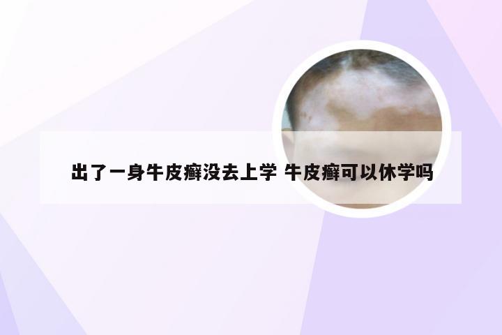 出了一身牛皮癣没去上学 牛皮癣可以休学吗