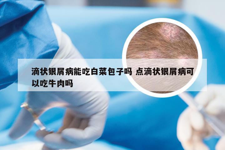 滴状银屑病能吃白菜包子吗 点滴状银屑病可以吃牛肉吗