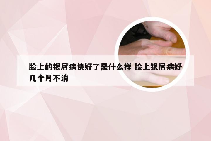 脸上的银屑病快好了是什么样 脸上银屑病好几个月不消
