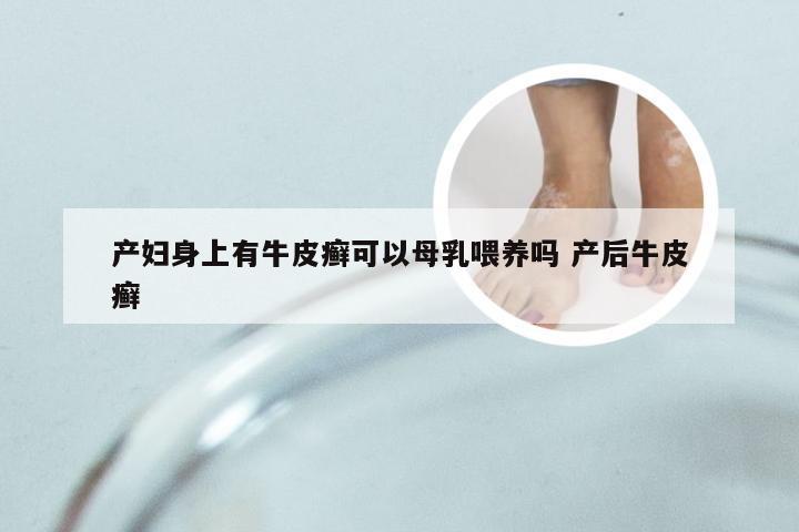 产妇身上有牛皮癣可以母乳喂养吗 产后牛皮癣