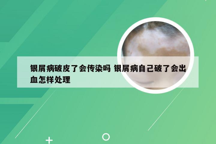 银屑病破皮了会传染吗 银屑病自己破了会出血怎样处理