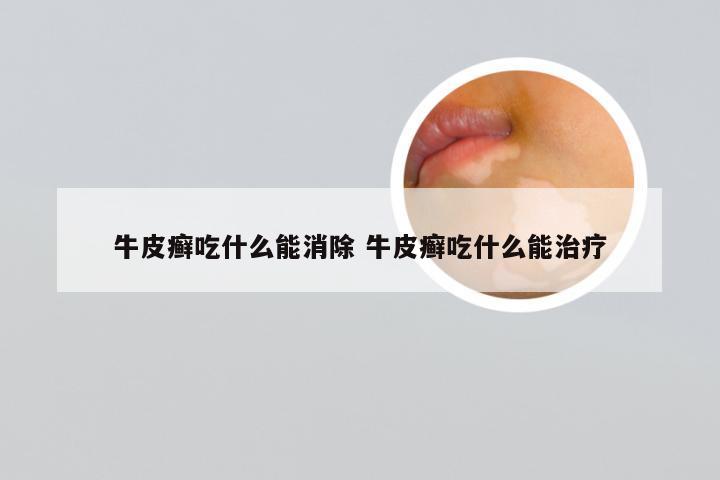牛皮癣吃什么能消除 牛皮癣吃什么能治疗