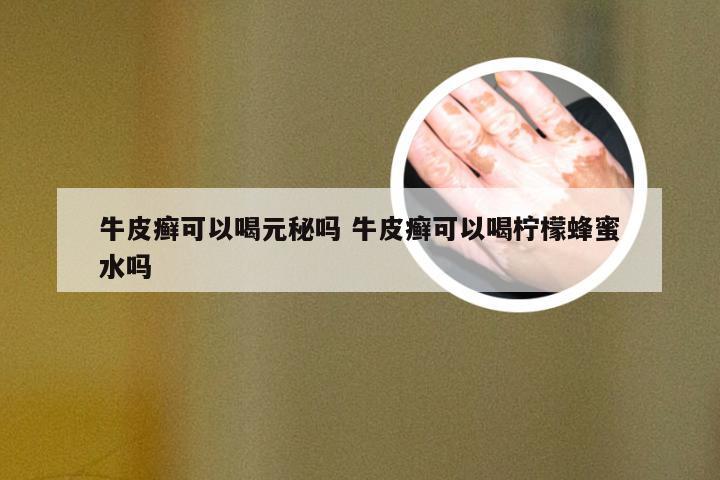牛皮癣可以喝元秘吗 牛皮癣可以喝柠檬蜂蜜水吗