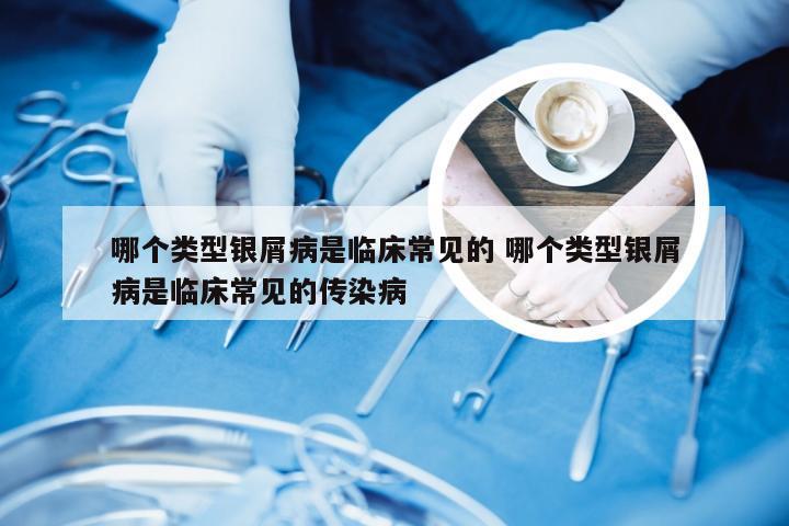 哪个类型银屑病是临床常见的 哪个类型银屑病是临床常见的传染病