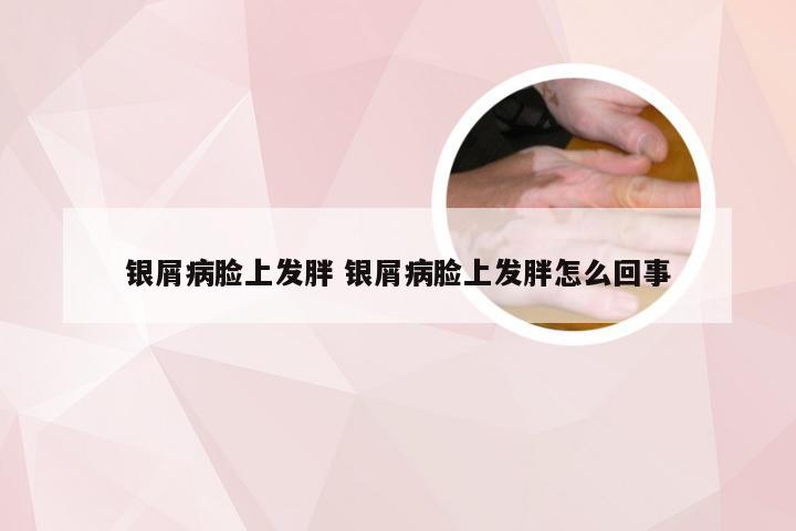 银屑病脸上发胖 银屑病脸上发胖怎么回事