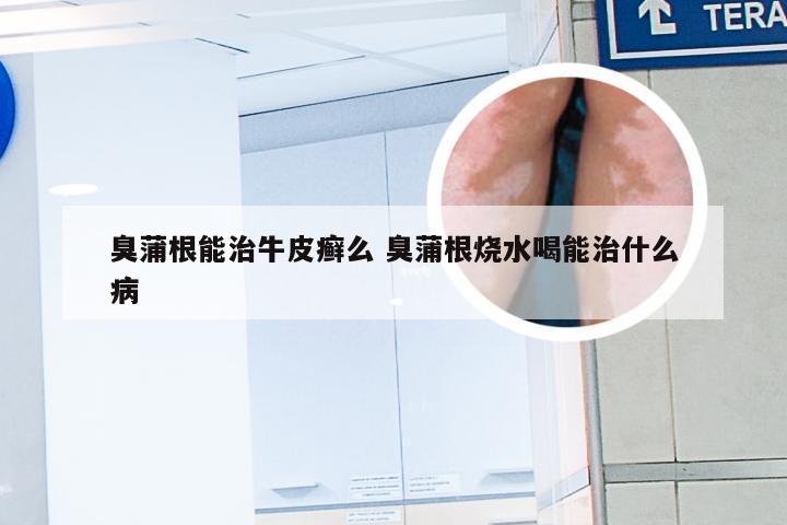 臭蒲根能治牛皮癣么 臭蒲根烧水喝能治什么病