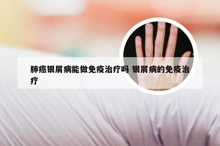 肺癌银屑病能做免疫治疗吗 银屑病的免疫治疗