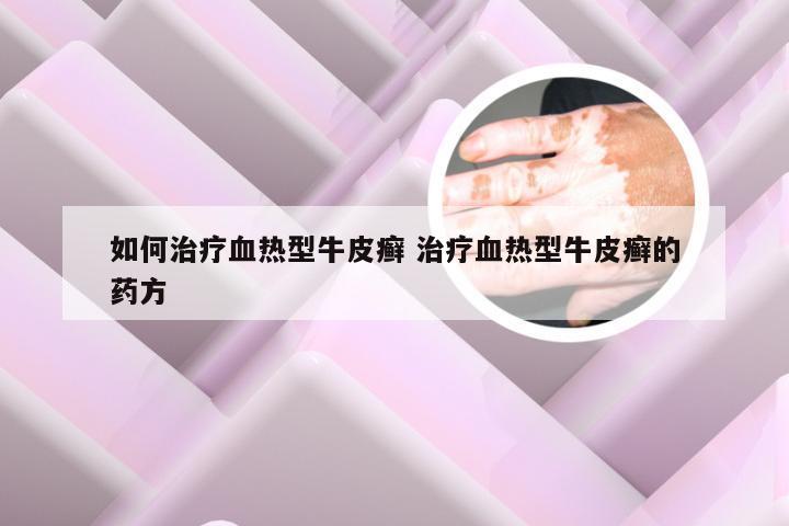 如何治疗血热型牛皮癣 治疗血热型牛皮癣的药方