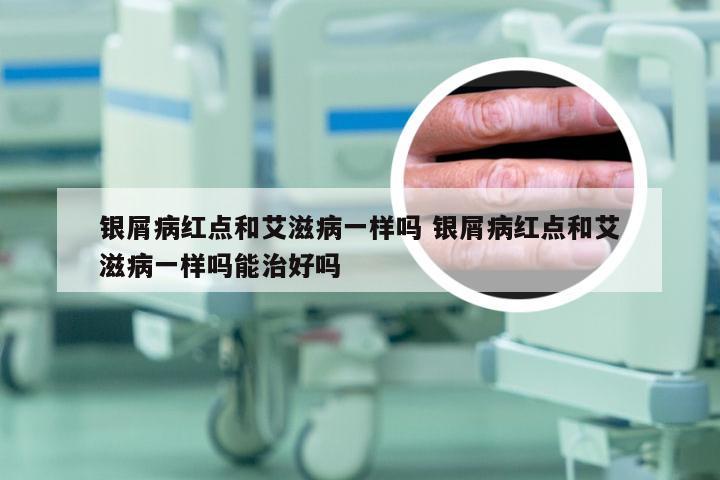 银屑病红点和艾滋病一样吗 银屑病红点和艾滋病一样吗能治好吗