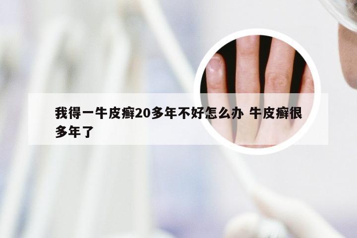 我得一牛皮癣20多年不好怎么办 牛皮癣很多年了