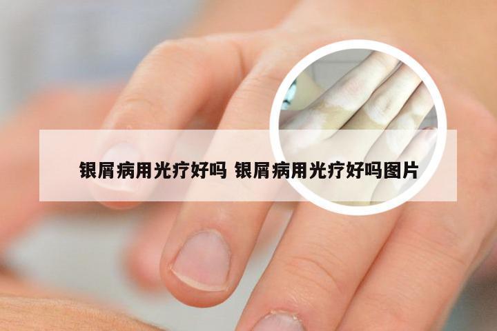 银屑病用光疗好吗 银屑病用光疗好吗图片