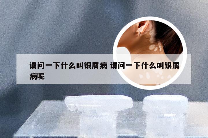 请问一下什么叫银屑病 请问一下什么叫银屑病呢