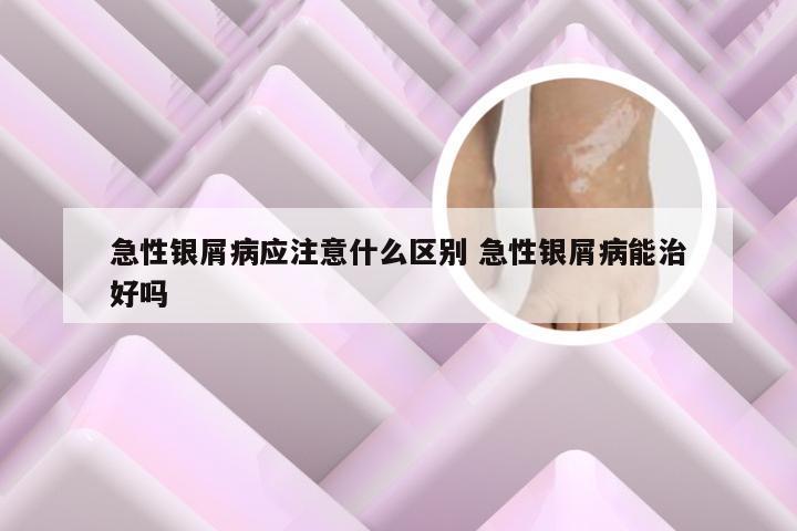 急性银屑病应注意什么区别 急性银屑病能治好吗
