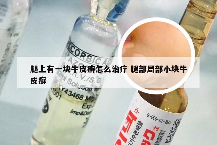 腿上有一块牛皮癣怎么治疗 腿部局部小块牛皮癣