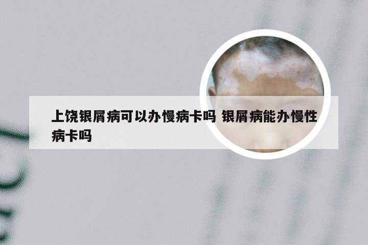 上饶银屑病可以办慢病卡吗 银屑病能办慢性病卡吗