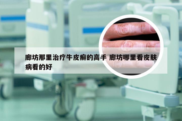 廊坊那里治疗牛皮癣的高手 廊坊哪里看皮肤病看的好