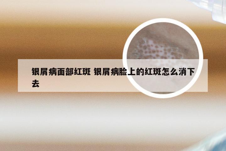 银屑病面部红斑 银屑病脸上的红斑怎么消下去