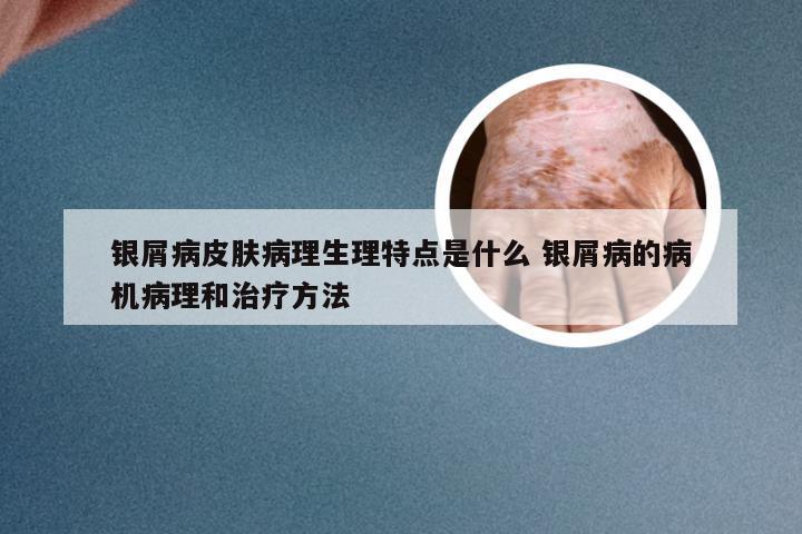 银屑病皮肤病理生理特点是什么 银屑病的病机病理和治疗方法