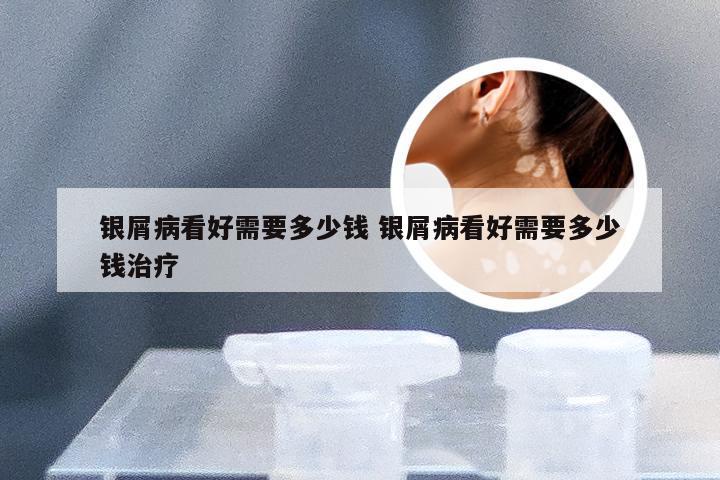 银屑病看好需要多少钱 银屑病看好需要多少钱治疗