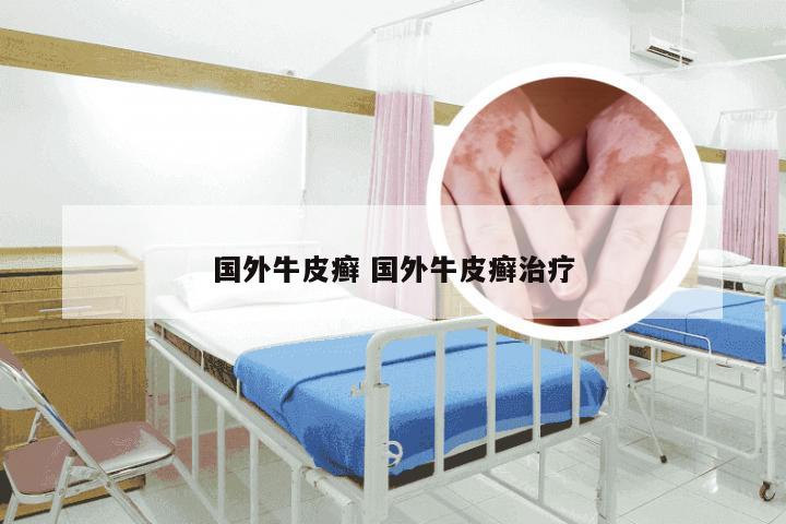 国外牛皮癣 国外牛皮癣治疗