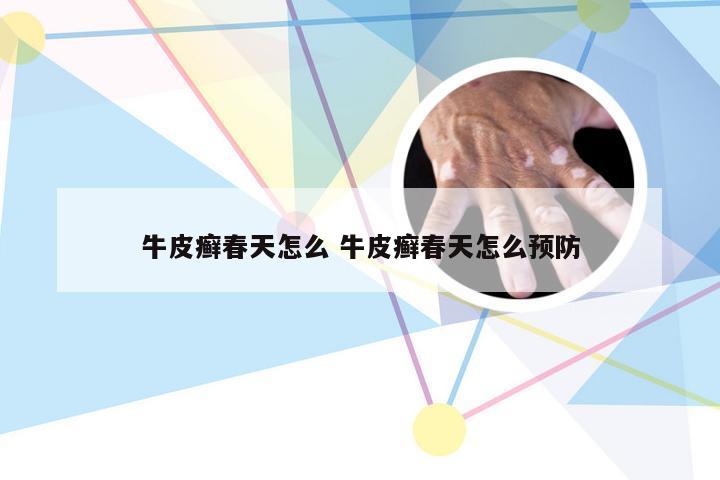 牛皮癣春天怎么 牛皮癣春天怎么预防