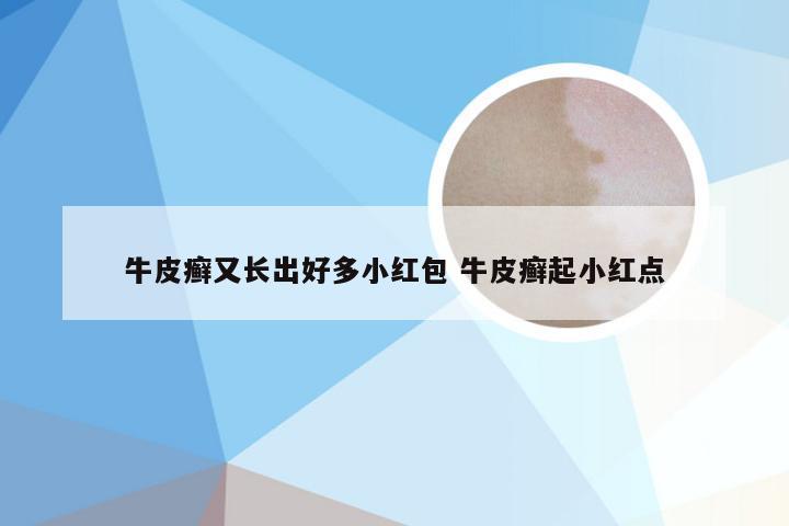 牛皮癣又长出好多小红包 牛皮癣起小红点