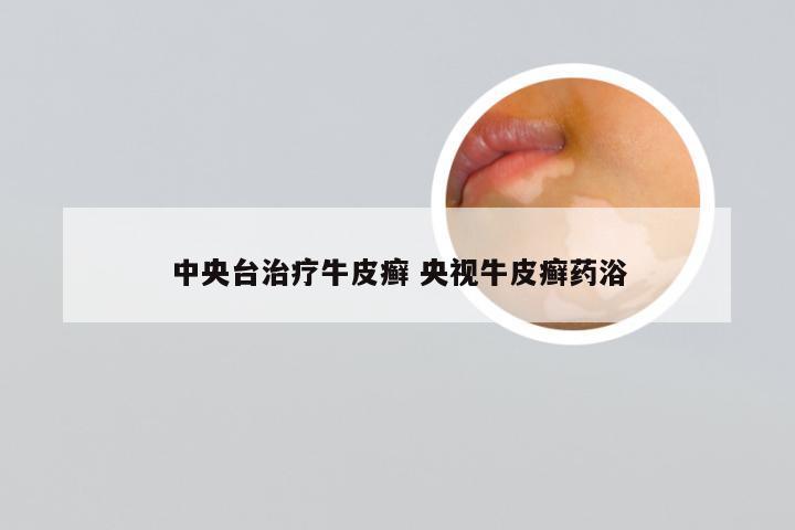 中央台治疗牛皮癣 央视牛皮癣药浴