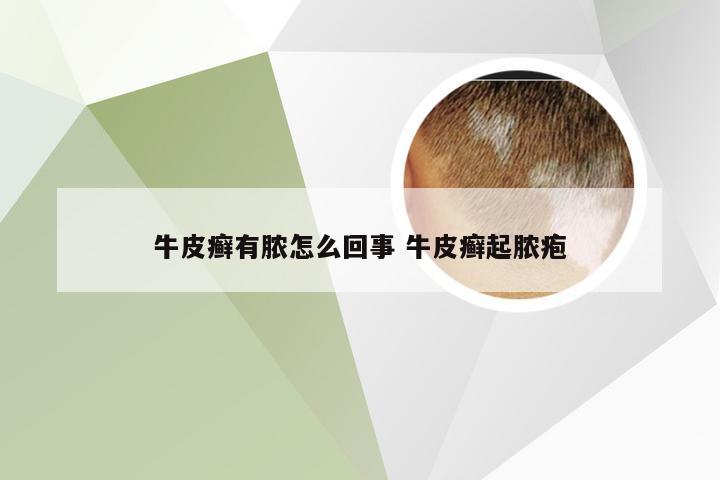 牛皮癣有脓怎么回事 牛皮癣起脓疱