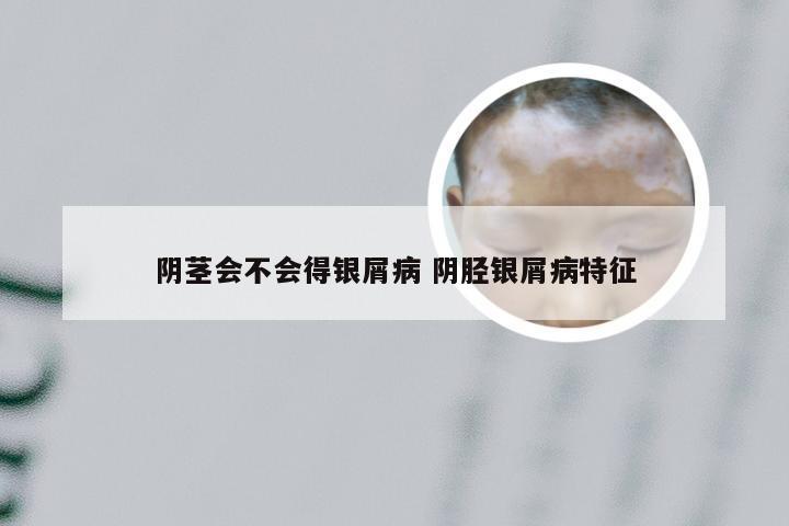 阴茎会不会得银屑病 阴胫银屑病特征