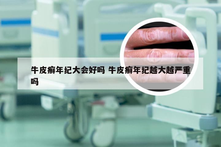 牛皮癣年纪大会好吗 牛皮癣年纪越大越严重吗