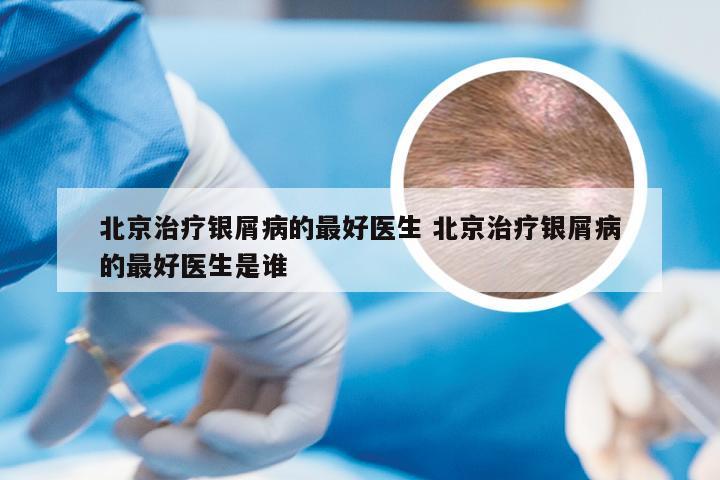 北京治疗银屑病的最好医生 北京治疗银屑病的最好医生是谁
