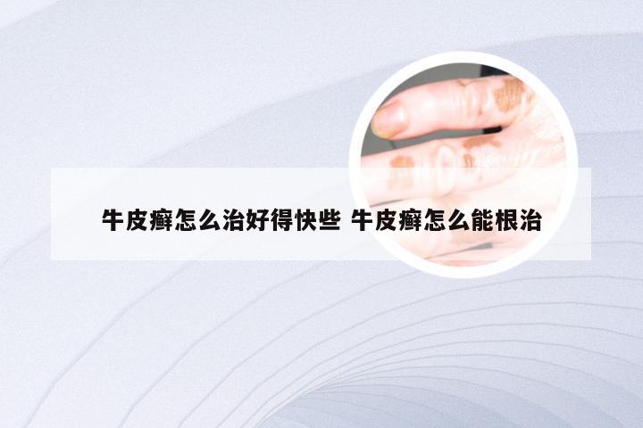 牛皮癣怎么治好得快些 牛皮癣怎么能根治