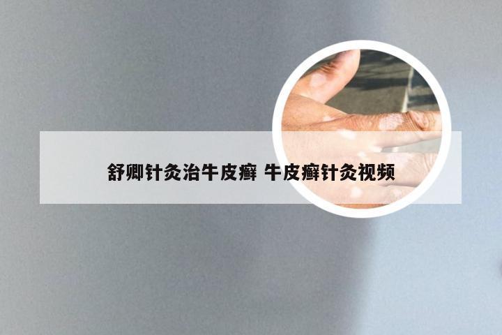 舒卿针灸治牛皮癣 牛皮癣针灸视频