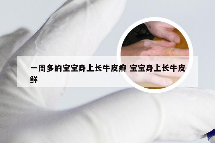一周多的宝宝身上长牛皮癣 宝宝身上长牛皮鲜