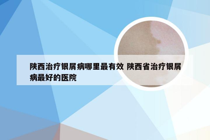 陕西治疗银屑病哪里最有效 陕西省治疗银屑病最好的医院