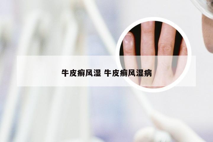 牛皮癣风湿 牛皮癣风湿病