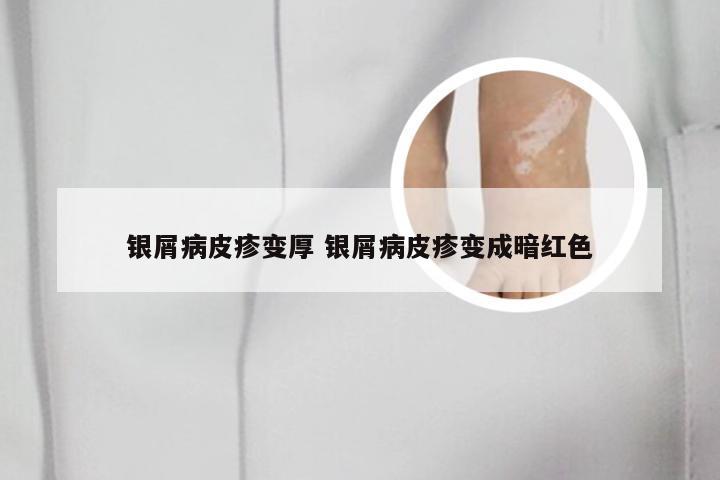 银屑病皮疹变厚 银屑病皮疹变成暗红色