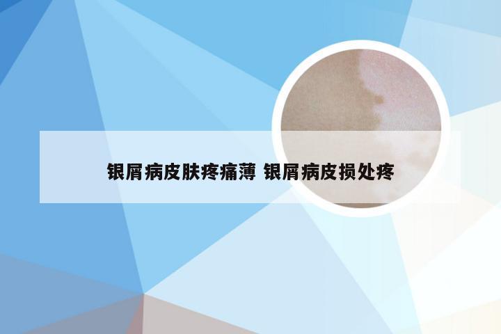 银屑病皮肤疼痛薄 银屑病皮损处疼