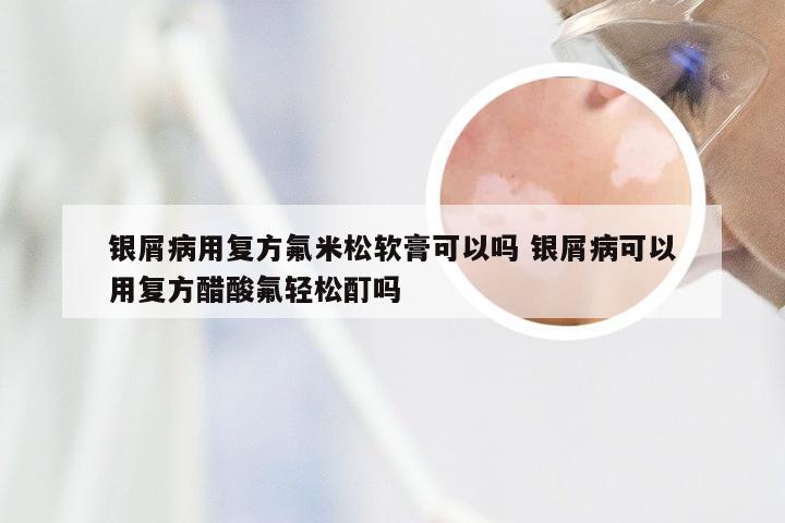 银屑病用复方氟米松软膏可以吗 银屑病可以用复方醋酸氟轻松酊吗