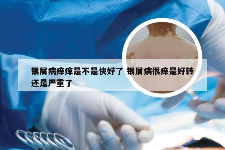 银屑病痒痒是不是快好了 银屑病很痒是好转还是严重了