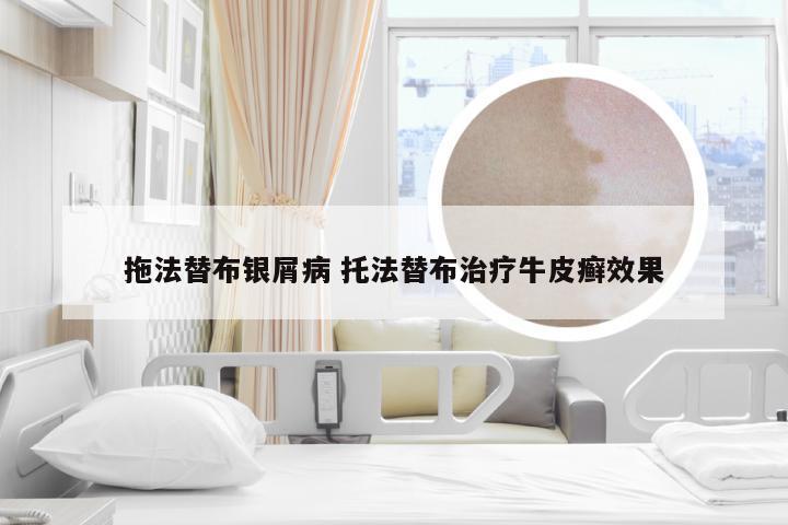 拖法替布银屑病 托法替布治疗牛皮癣效果