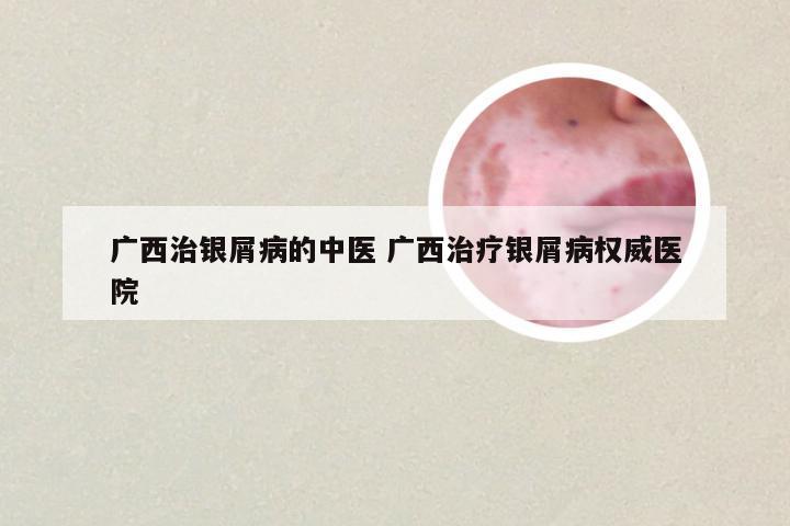 广西治银屑病的中医 广西治疗银屑病权威医院